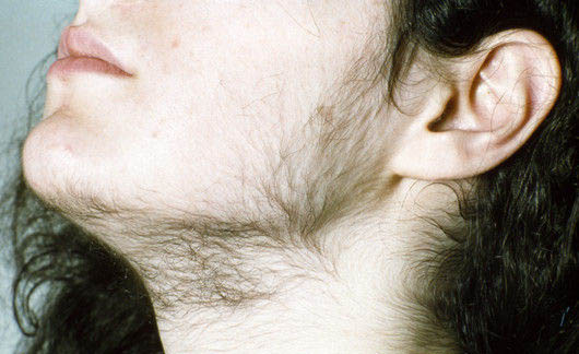 Лечение нежелательного роста волос у женщин по мужскому типу | Cochrane