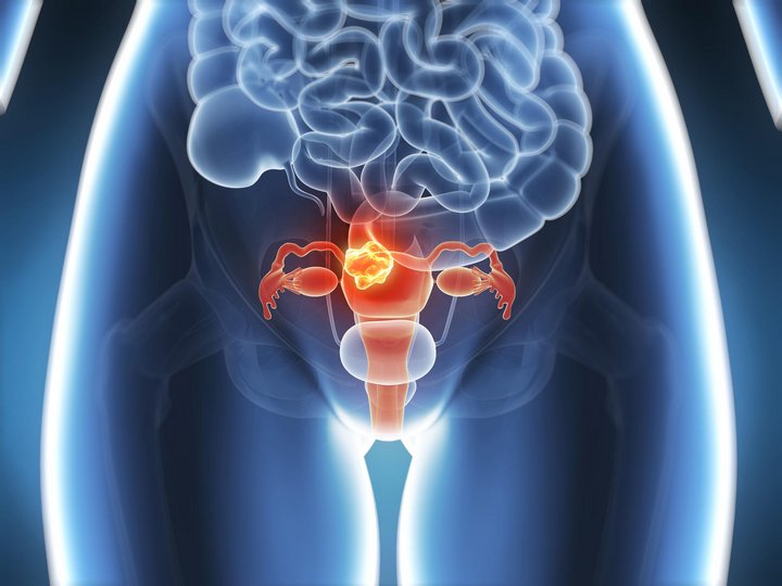 Эрозия, ВПЧ и рак шейки матки: О раке шейки матки