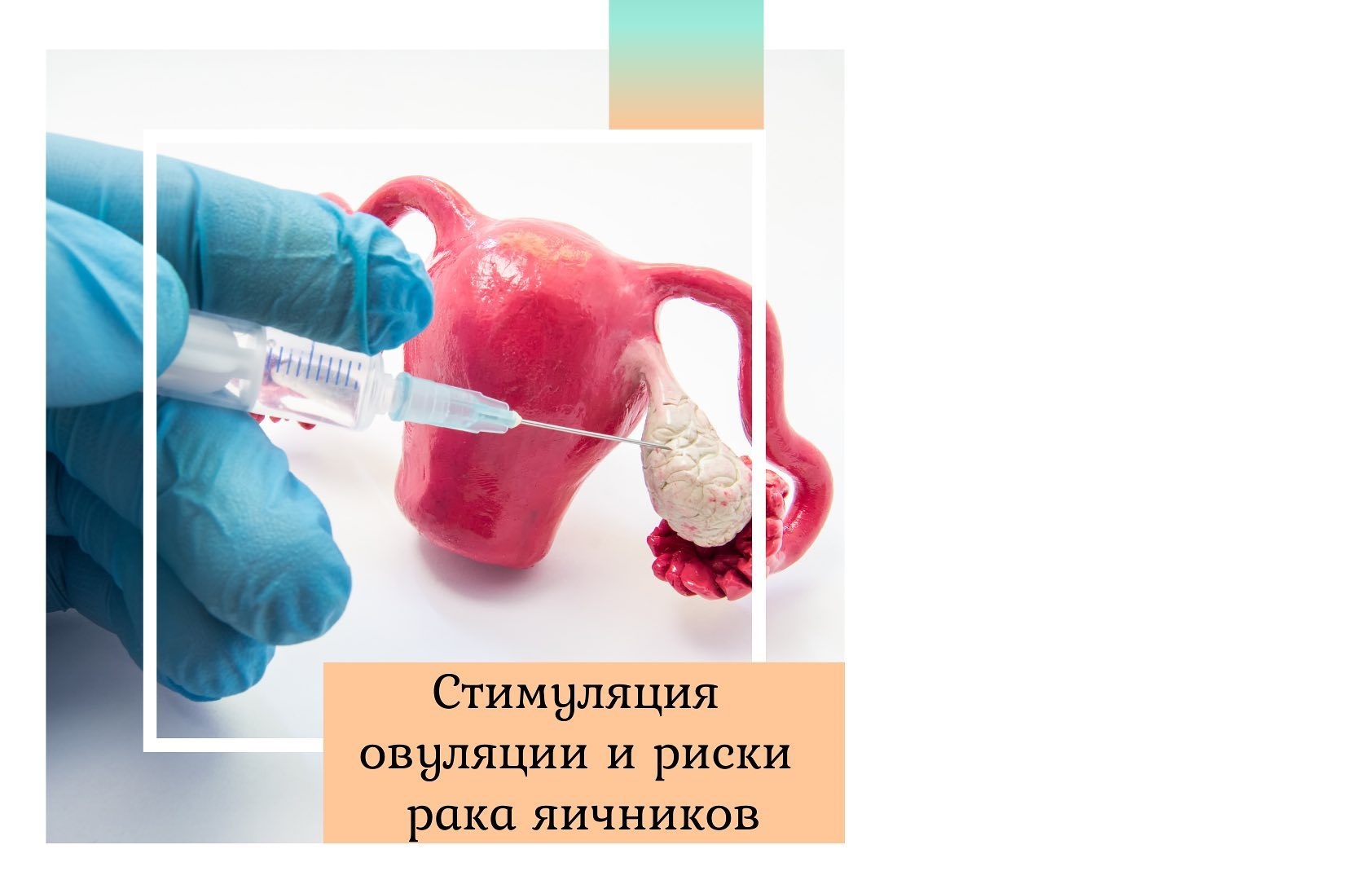 Стимуляция овуляции и риск рака яичников Доктор Елена