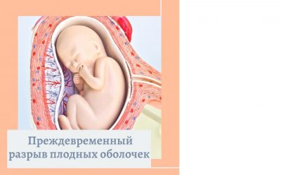 Преждевременный разрыв плодных оболочек